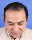 Before Hair Transplant&nbsp;Front